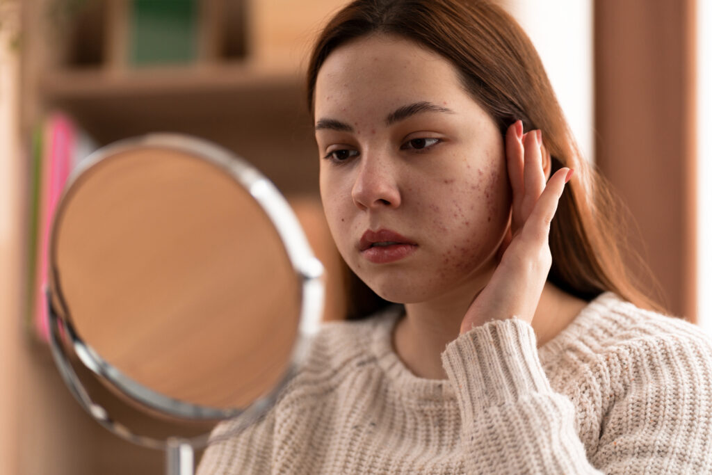 Best Acne Treatments for Teens — What Actually Works for Young Skin