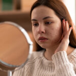 Best Acne Treatments for Teens — What Actually Works for Young Skin