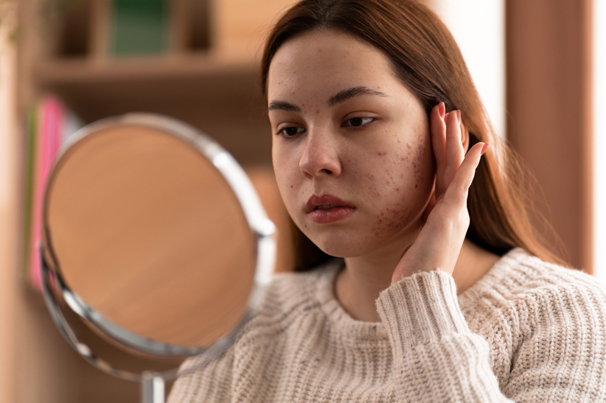 Best Acne Treatments for Teens — What Actually Works for Young Skin