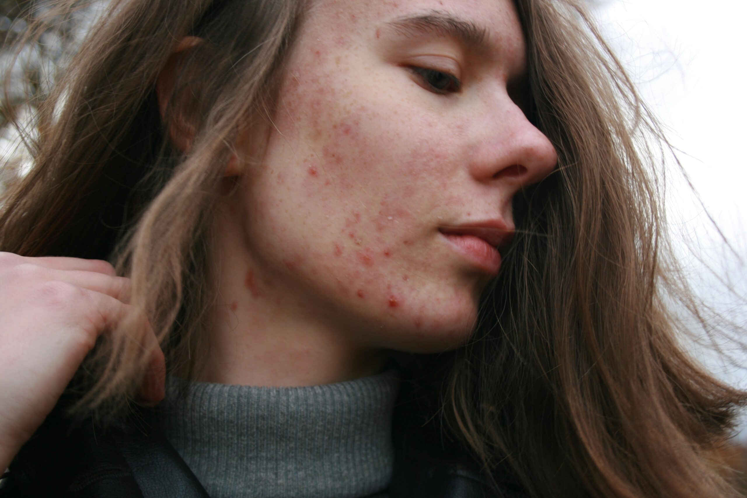  MDacne