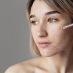 Acne Treatments: What Actually Works for Clear, Healthy Skin
