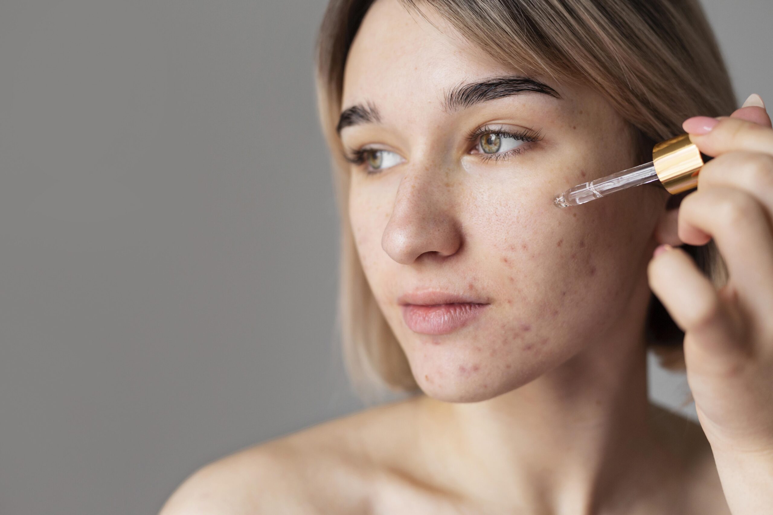 Acne Treatments: What Actually Works for Clear, Healthy Skin