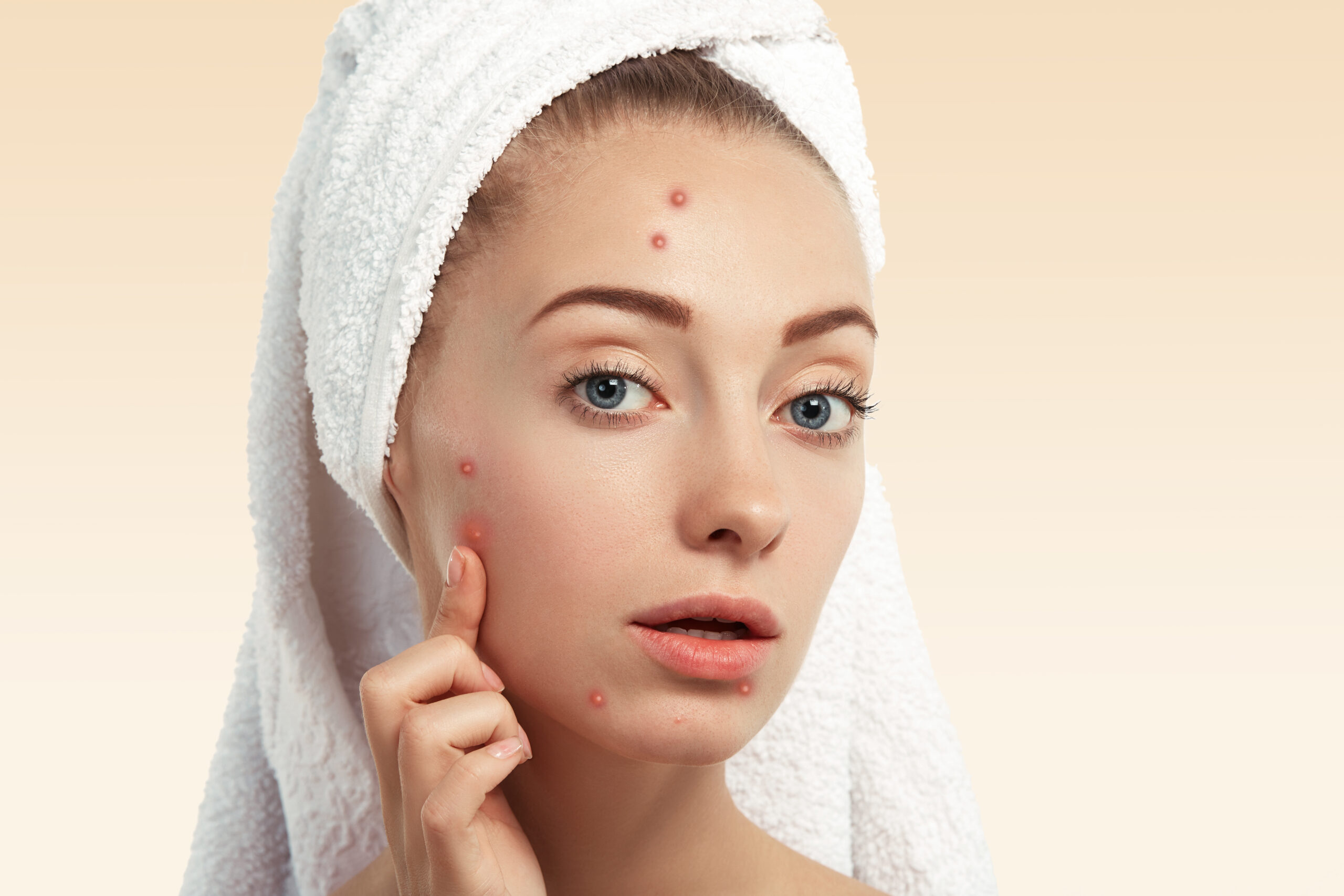 Best Spot Treatment: Clean & Clear Persa-Gel 10 (Benzoyl Peroxide)