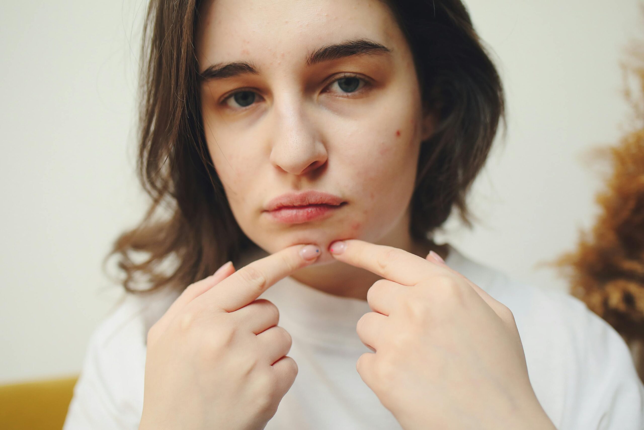 Best Acne Treatments — Your Complete Guide to Clearer Skin in 2026